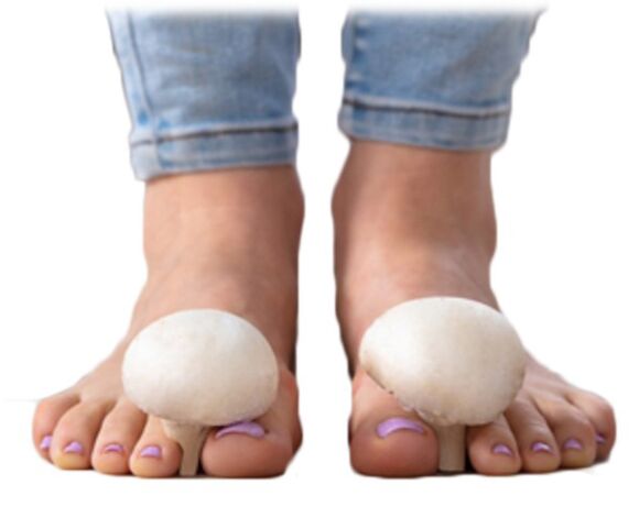 Mikoza na površini stopala i noktiju