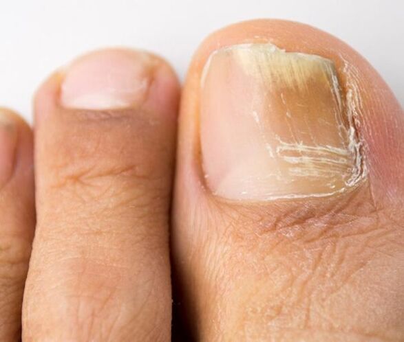 gljivična infekcija noktiju na nogama