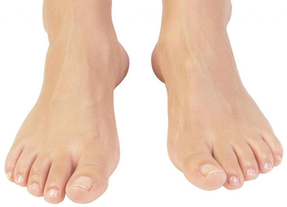 zdravi nokti na nogama nakon liječenja gljivica