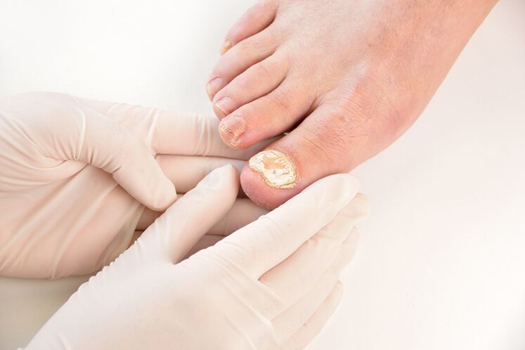 Prije propisivanja liječenja, liječnik treba dijagnosticirati gljivicu noktiju na nogama
