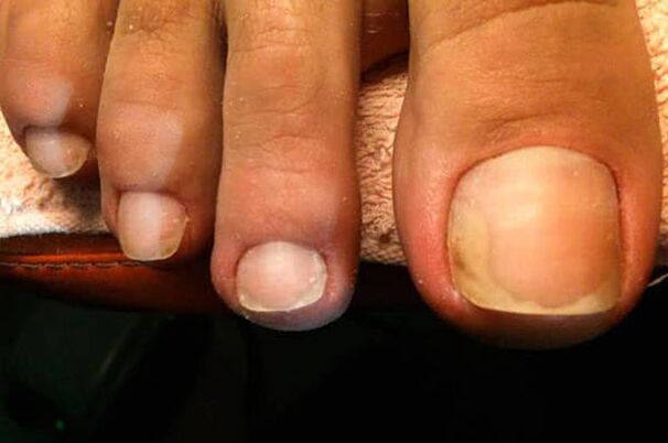 Gljivice na noktima počinju na nožnom palcu