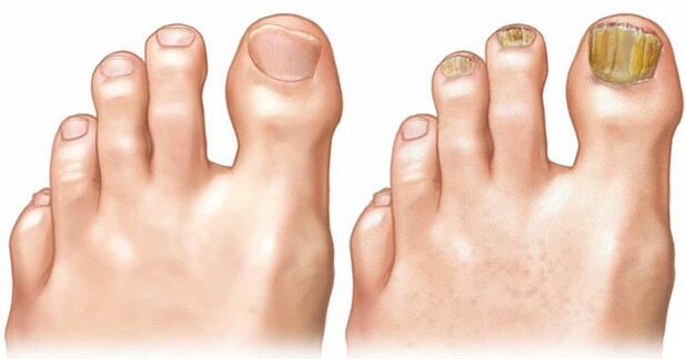 Normalni nokti (lijevo) i s manifestacijama onihomikoze (desno)