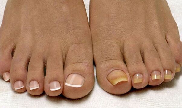 Zdravi nokti na nogama (lijevo) i oni zahvaćeni gljivicama (desno)