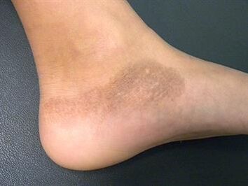 Mikoza stopala popraćena je promjenom tona kože