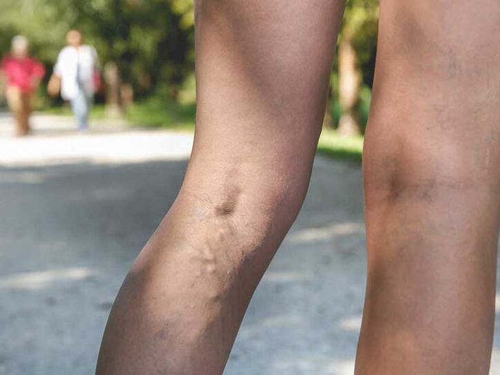 Proširene vene su faktor rizika za gljivičnu infekciju stopala
