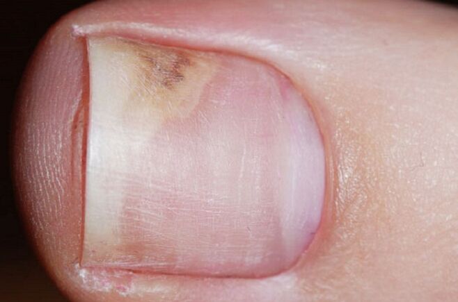 Znakovi onihomikoze u početnoj fazi - nedostatak sjaja, razmak između nokta i ležišta