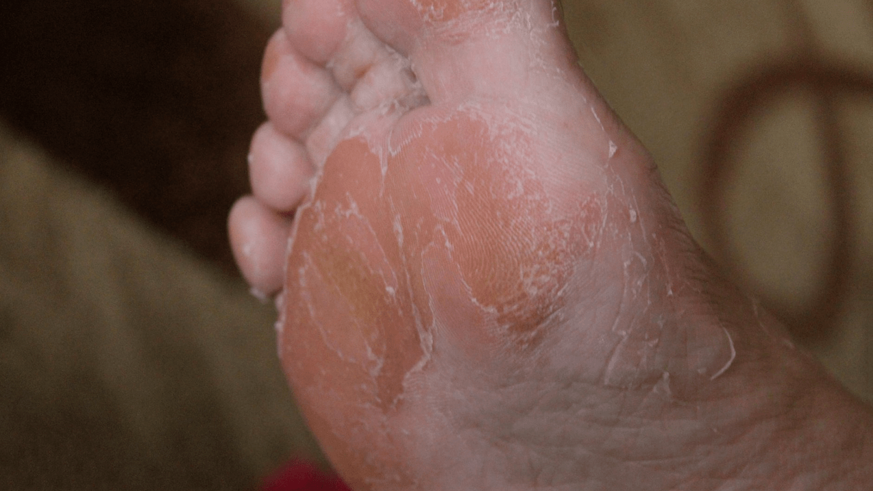 gljivice kože stopala