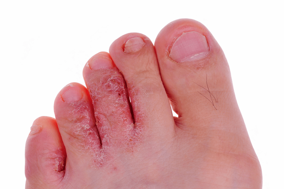 gljivična infekcija kože između nožnih prstiju