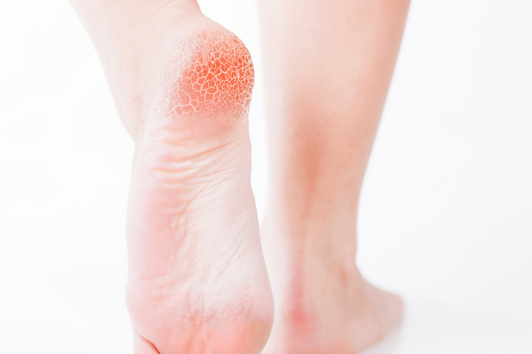 liječenje gljivica stopala u ranoj fazi