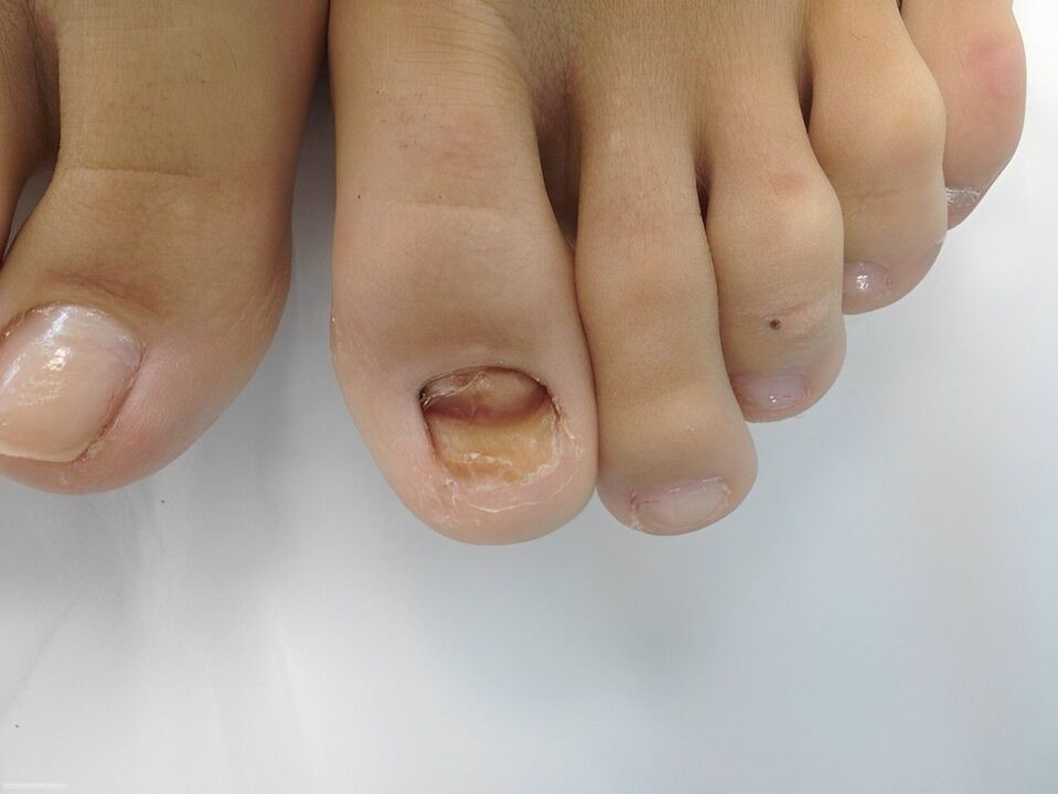 gljivična bolest noktiju