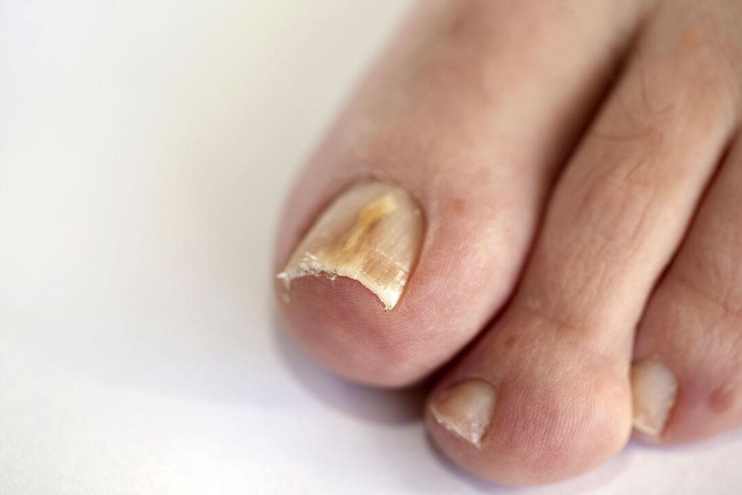simptomi gljivica na noktima nogu