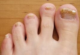 Runned Onyhomicosis
