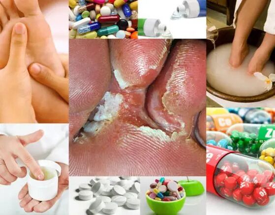 Interdigitalna mikoza i metode liječenja