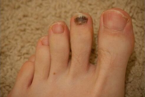 Korištenje oralnih i lokalnih lijekova