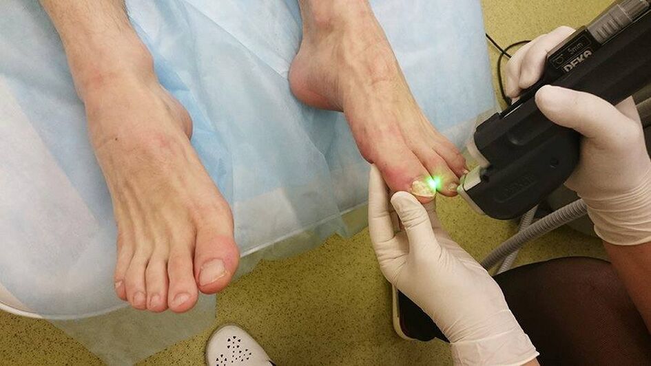 laserska terapija za gljivice noktiju